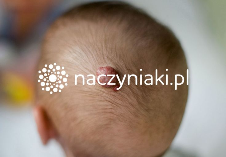 Naczyniaki